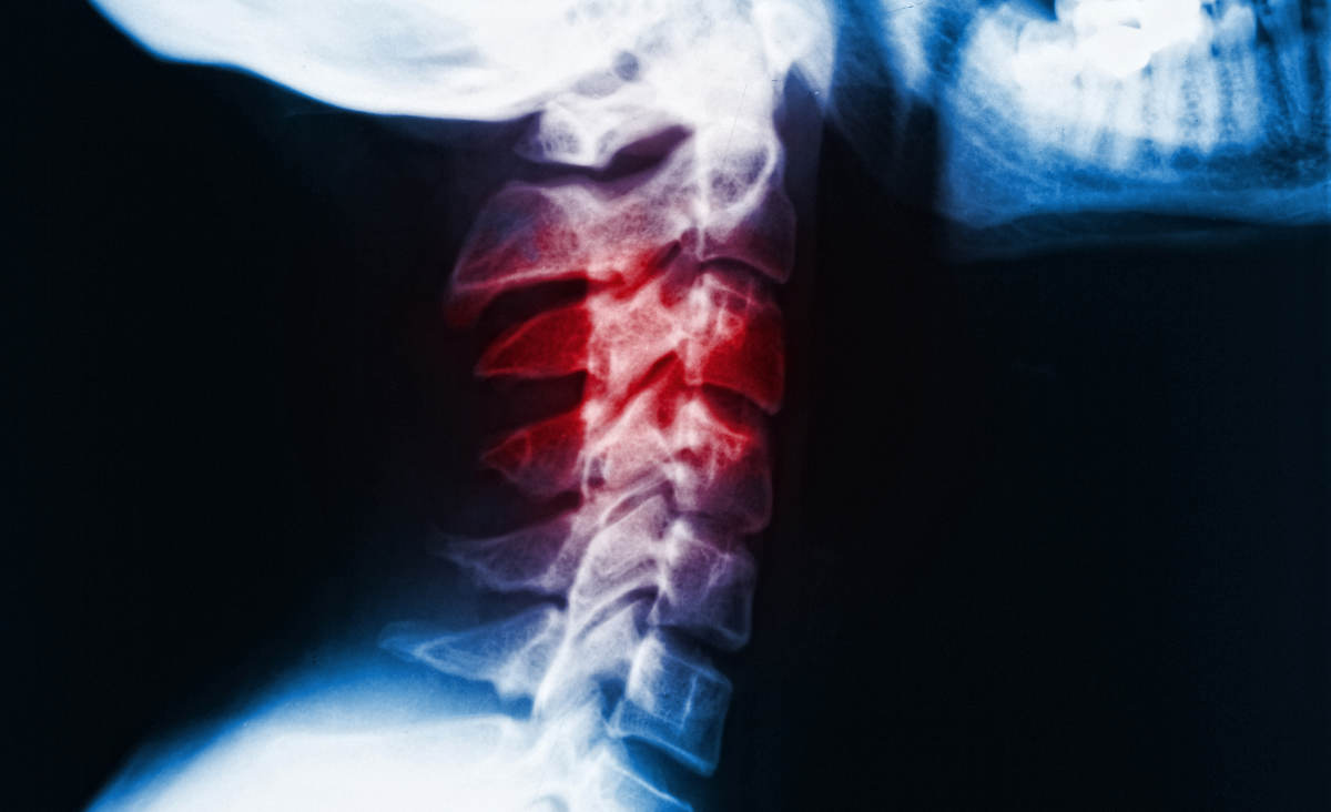 San Diego Back and Neck Injuries Attorney